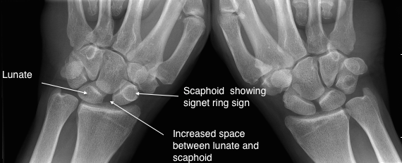 X-ray showing a scapholunate tear, with increased space between the lunate and scaphoid and the scaphoid showing a signet ring sign