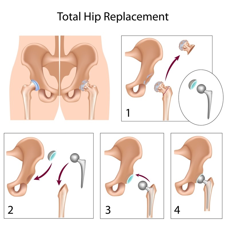 Total hip replacement procedure, showing the femoral head removed and replaced with a stem, ball, and cup